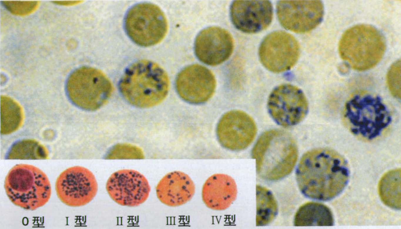图3-1-18 活体小红细胞-尿液沉渣实录-医学